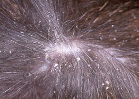 ツメダニ症（ケイレテイラ皮膚炎）は、イヌツメダニの寄生によりフケが大量発生する皮膚病です。